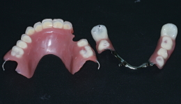 Removable Dentures